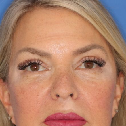 55 year old female underwent deep plane facelift, deep neck lift, upper blepharoplasty and lower blepharoplasty at Carson Williams Facial Plastic Surgery.