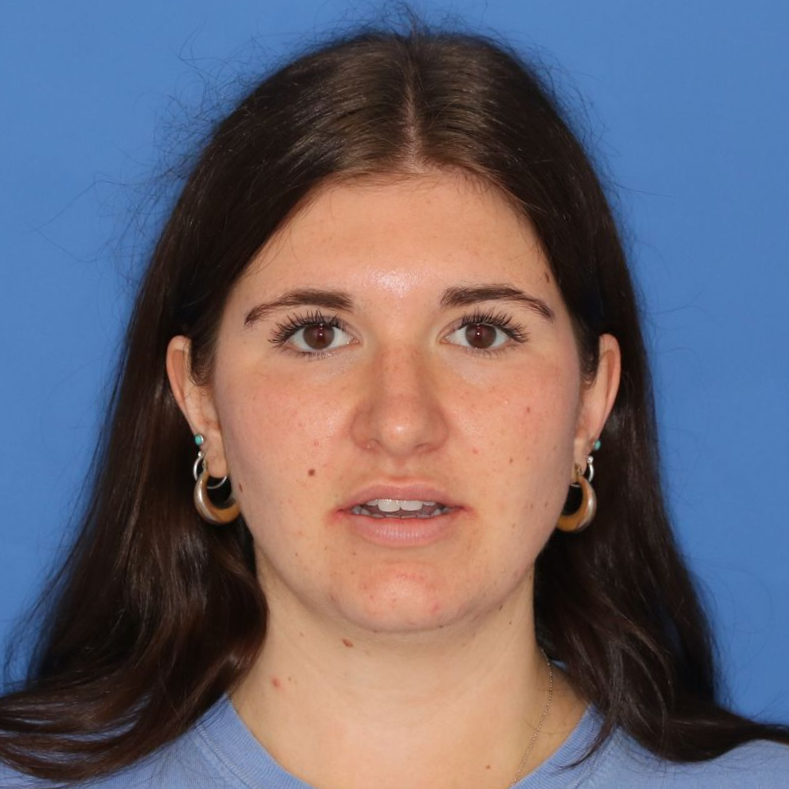 25 year old female after undergoing cosmetic rhinoplasty posing on a blue background