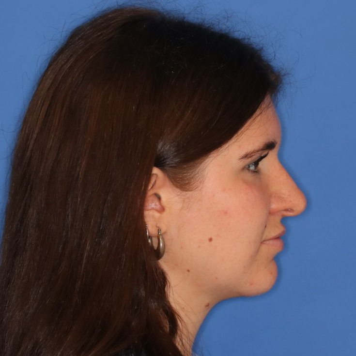 Side profile of a woman after receiving a rhinoplasty surgery