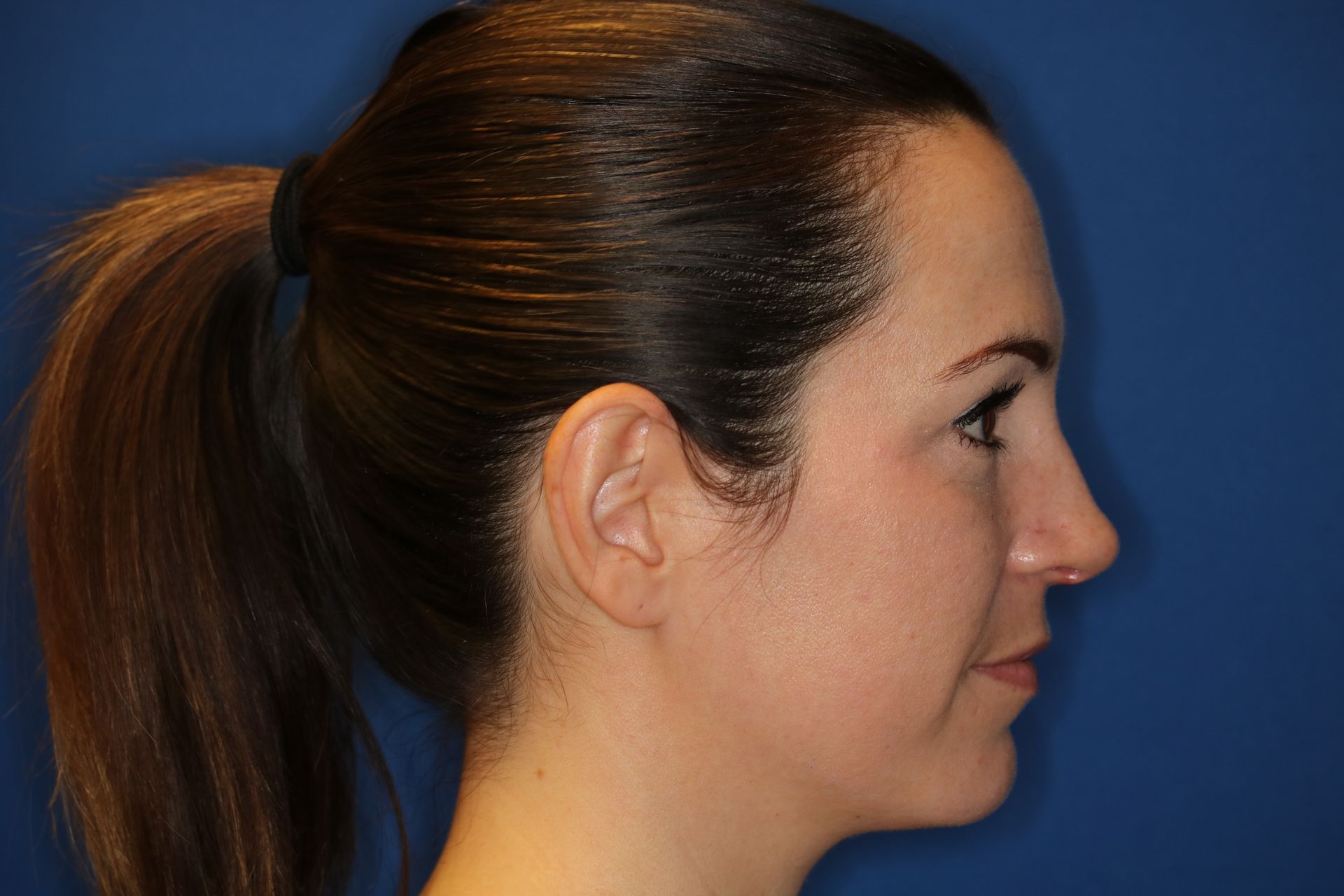Close up image of a woman's face after rhinoplasty surgery at Carson Williams MD Facial Plastic Surgery office in Leawood KS