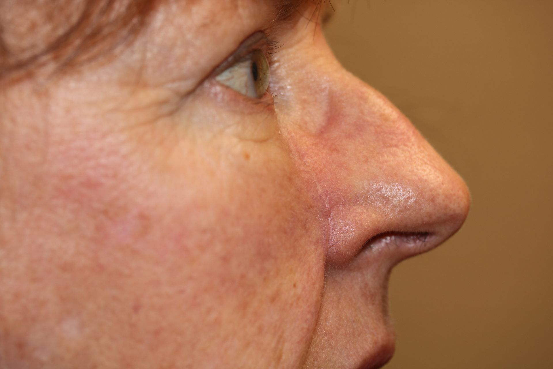 A close up of a  woman 's face who underwent Mohs surgery