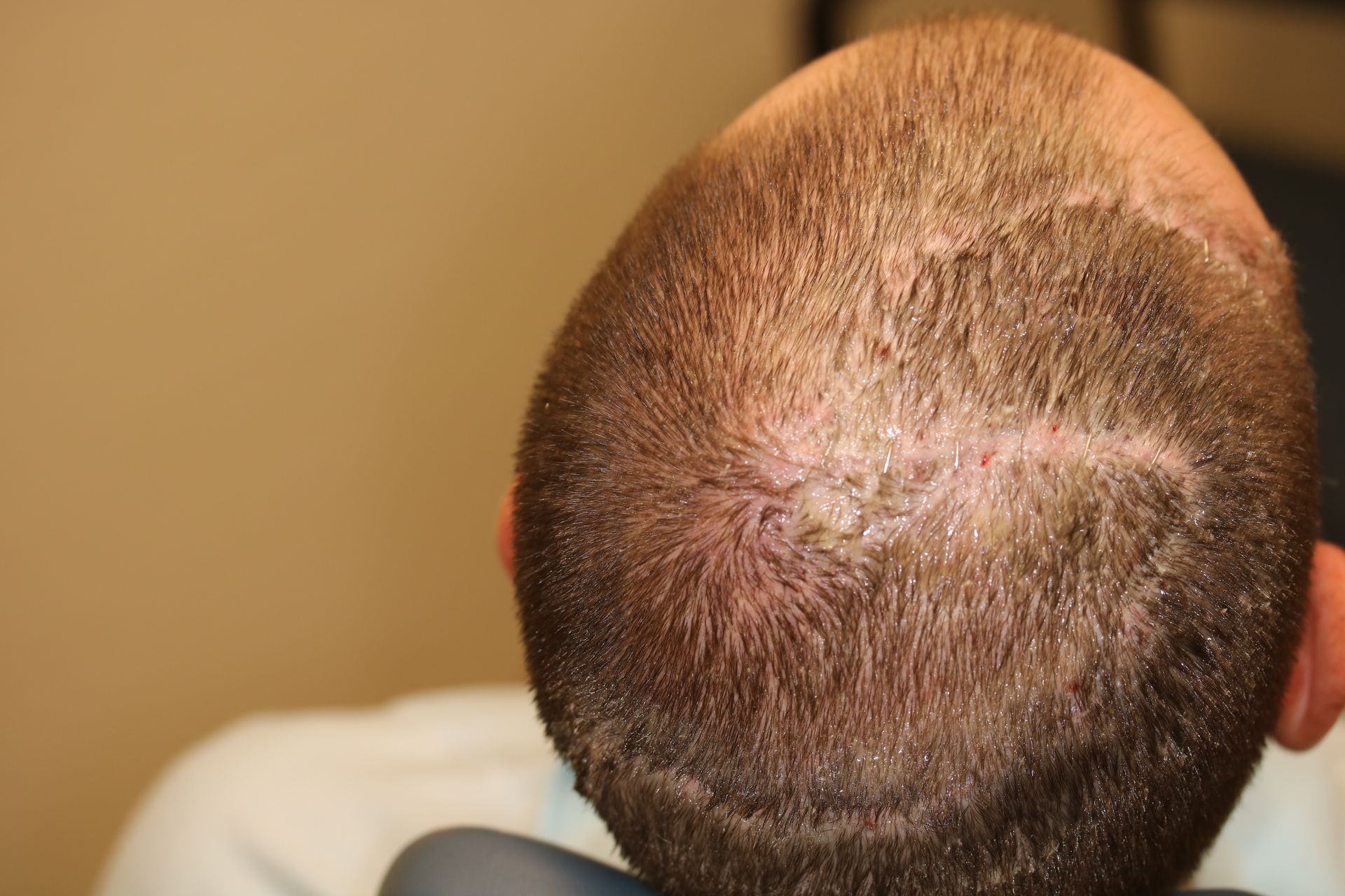 The back of a man 's head who underwent Mohs Surgery
