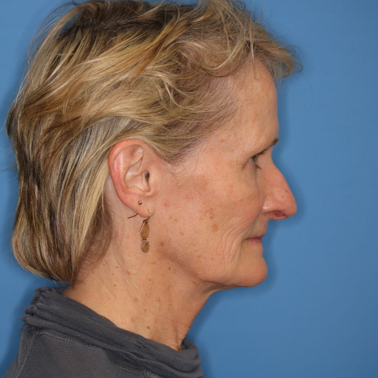 Woman facing profile against a blue backdrop; showcasing a brow lift before and after image