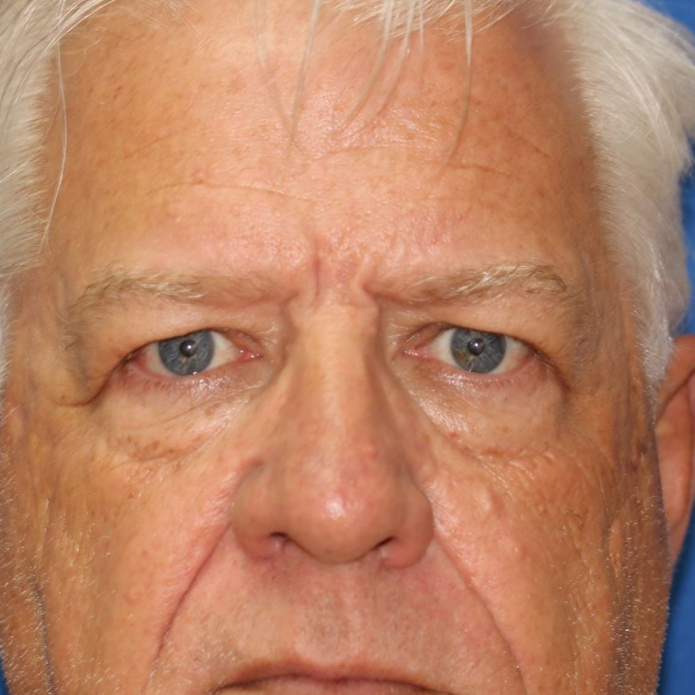 58 year old man who underwent bilateral upper blepharoplasty in office under local anesthesia