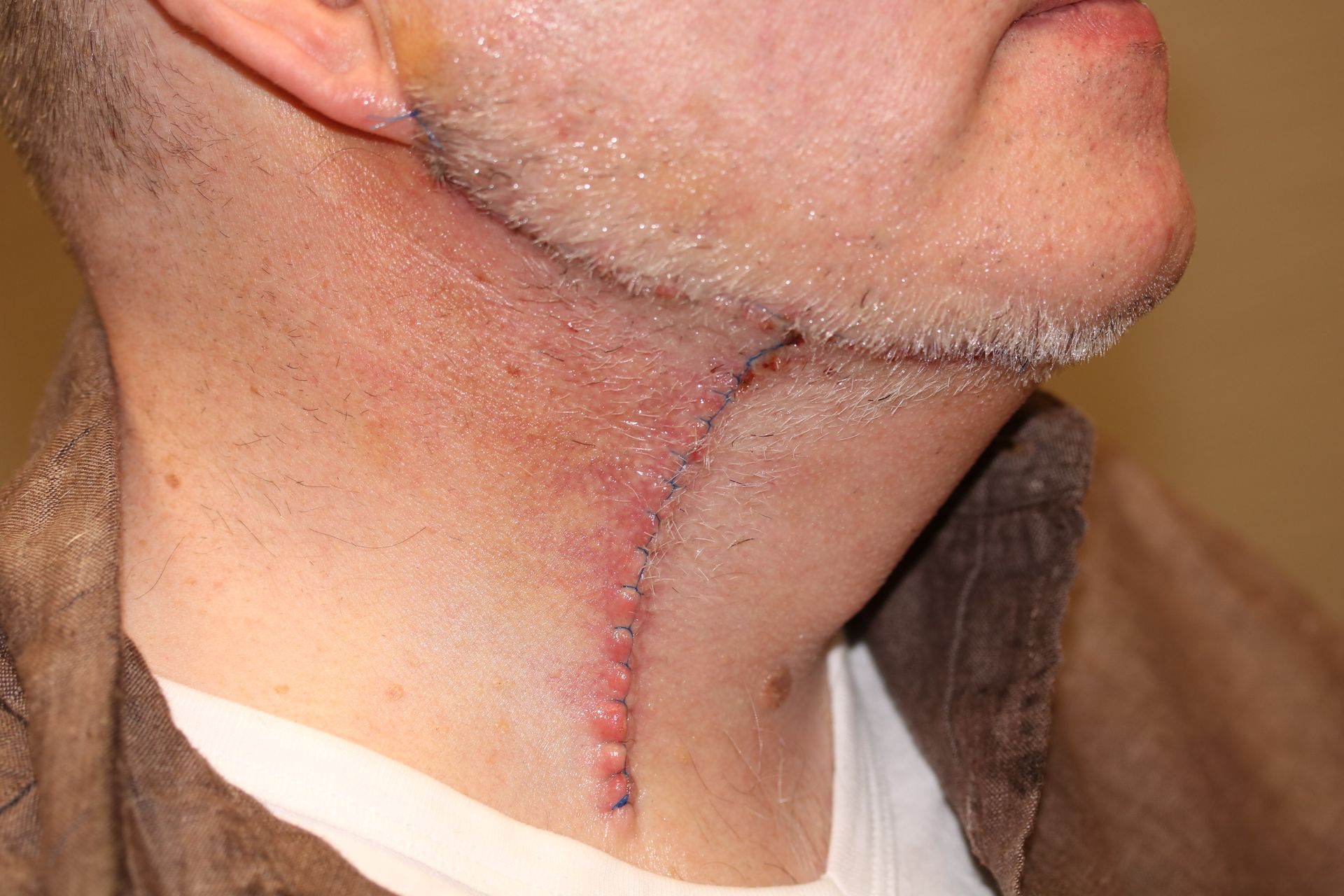 A man with a beard has a scar on his neck from Mohs surgery.