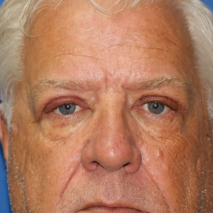 58 year old man who underwent bilateral upper blepharoplasty in office under local anesthesia