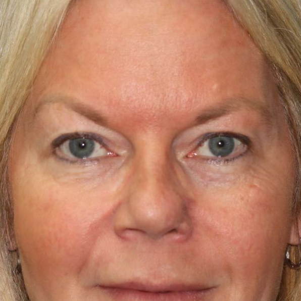 55 year old female who underwent bilateral upper blepharoplasty under local anesthesia in office