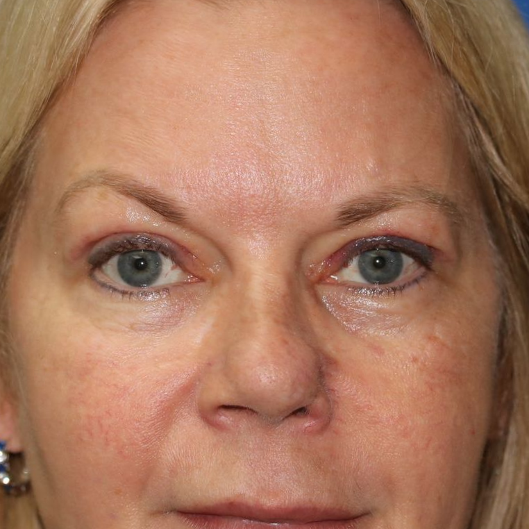 55 year old female who underwent bilateral upper blepharoplasty under local anesthesia in office