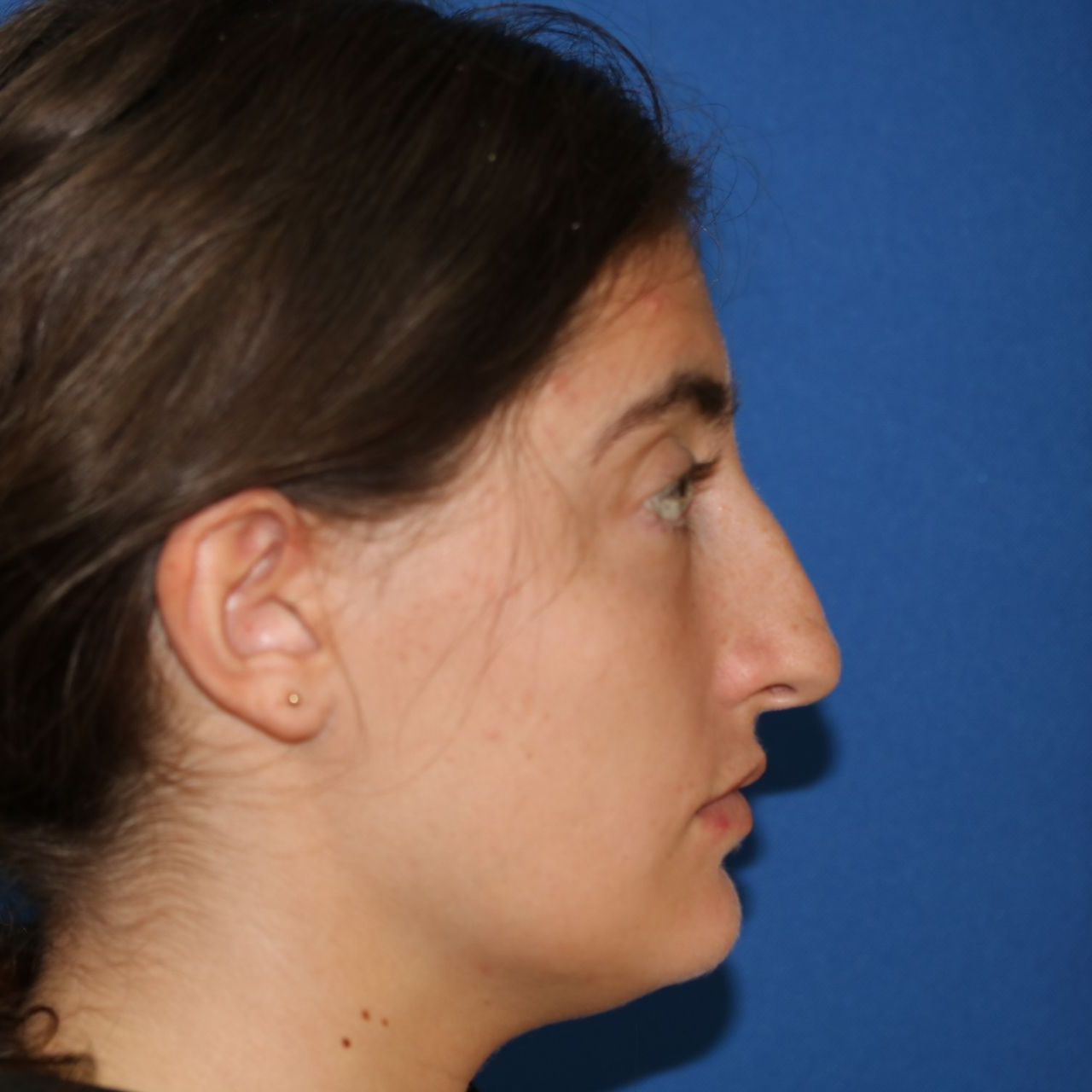 Close up image of a woman's face before rhinoplasty surgery at Carson Williams MD Facial Plastic Surgery office in Leawood KS