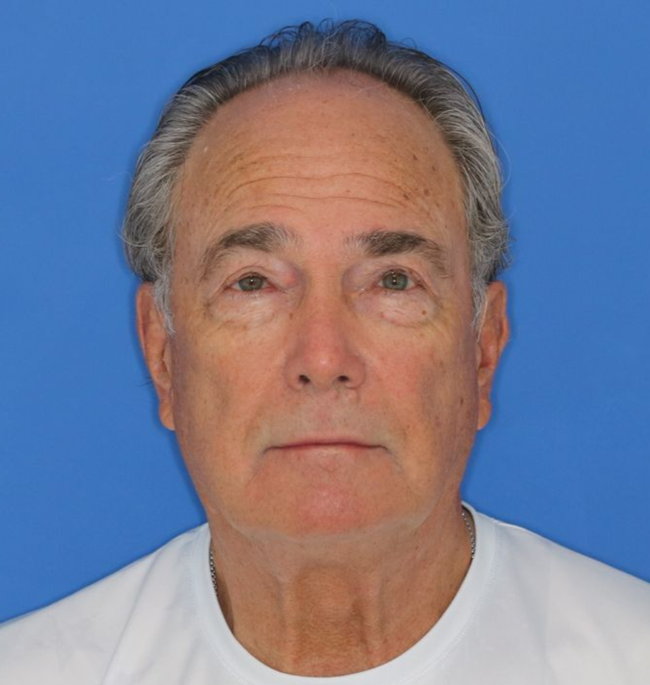 A 72 year old male posing for before photos of a bilateral upper blepharoplasty.