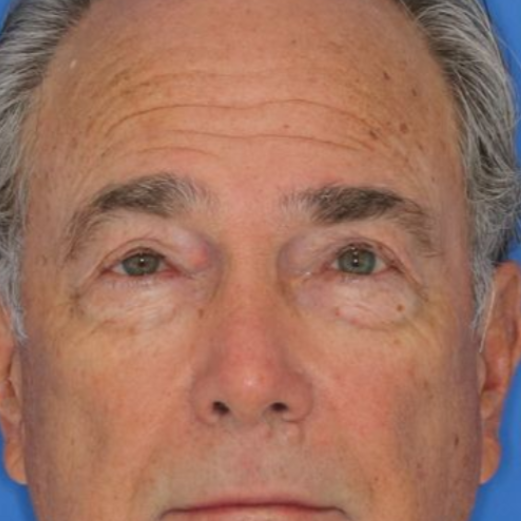 A 72 year old male posing for before photos of a bilateral upper blepharoplasty.
