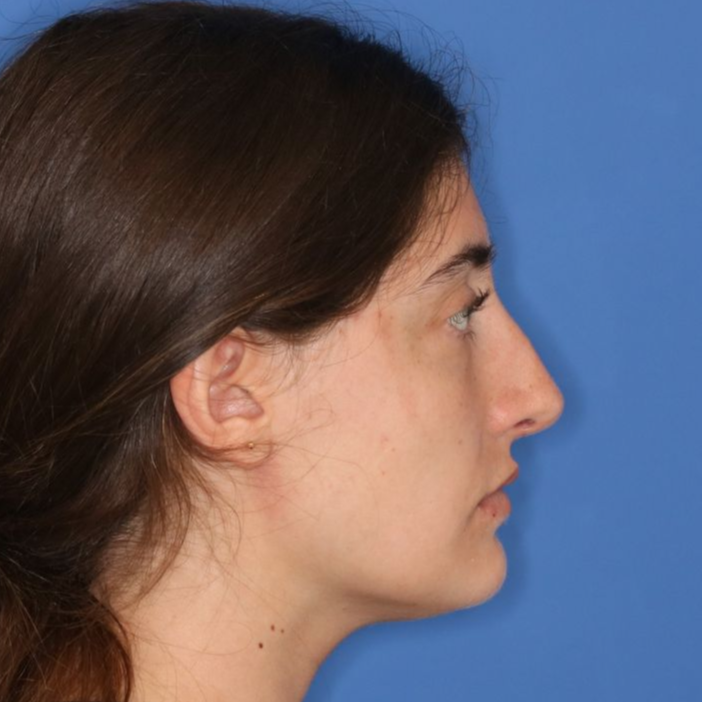 Close up image of a woman's face after rhinoplasty surgery at Carson Williams MD Facial Plastic Surgery office in Leawood KS