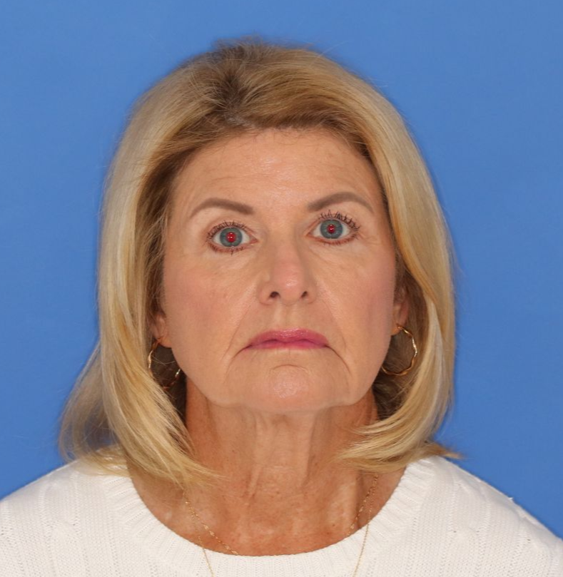71 year old female before photos on a blue background