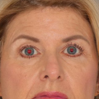 71 year old female posing on a blue background for a before photo