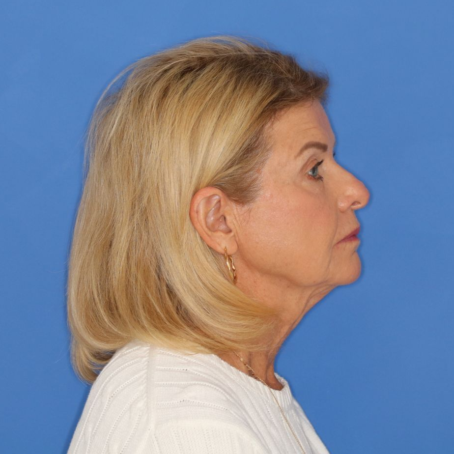 71 year old female before undergoing surgery posing on a blue background