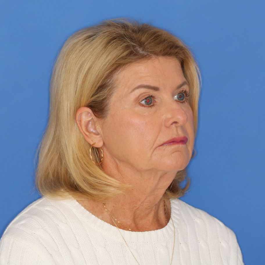 71 year old female before surgery posing on a blue background