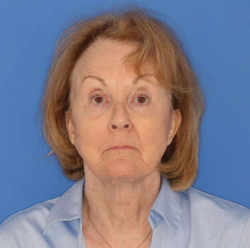 76 year old female underwent deep plane face and neck lift and is posing for before photos