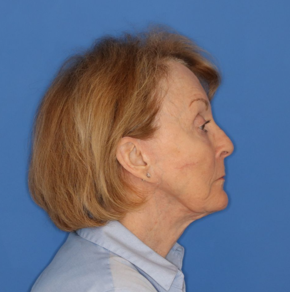 76 year old female underwent deep plane face and neck lift facing to the right for before photos