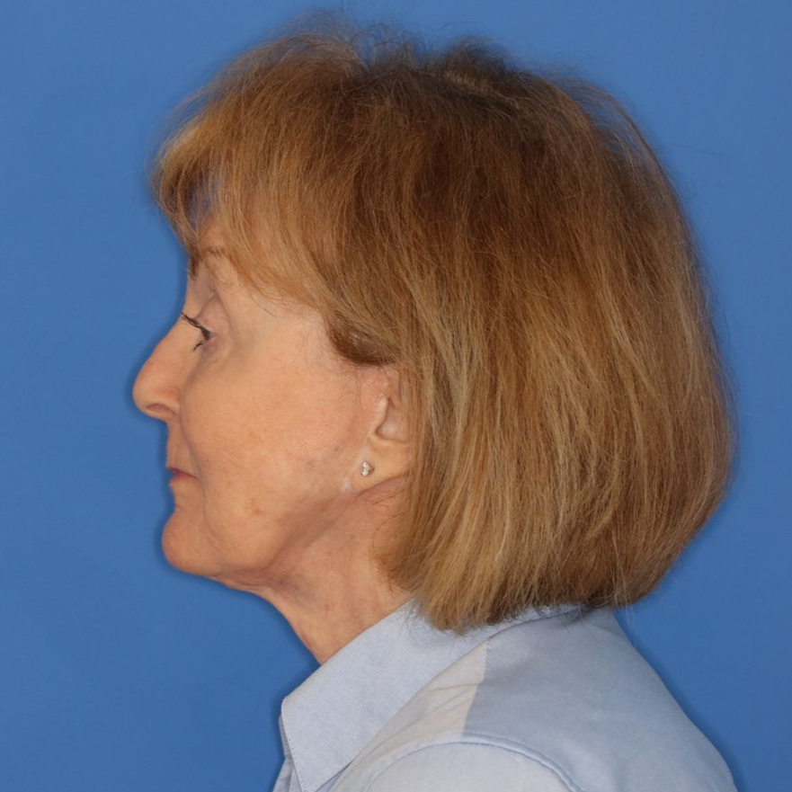 76 year old female facing to the left in front of a blue background