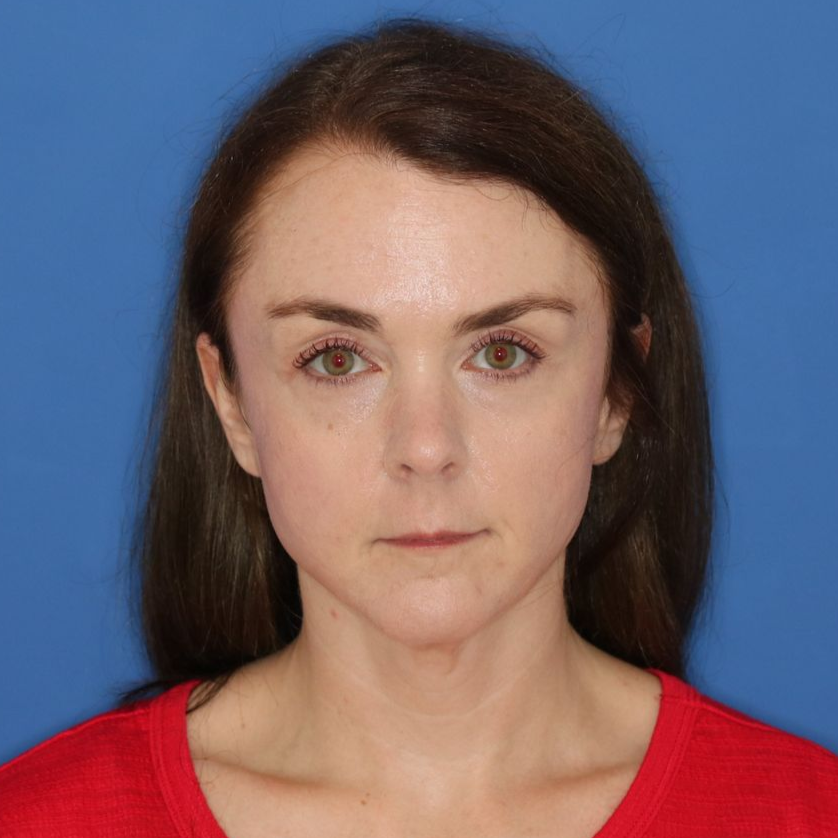 43 year old female underwent deep plane face and neck lift posing for a before photo