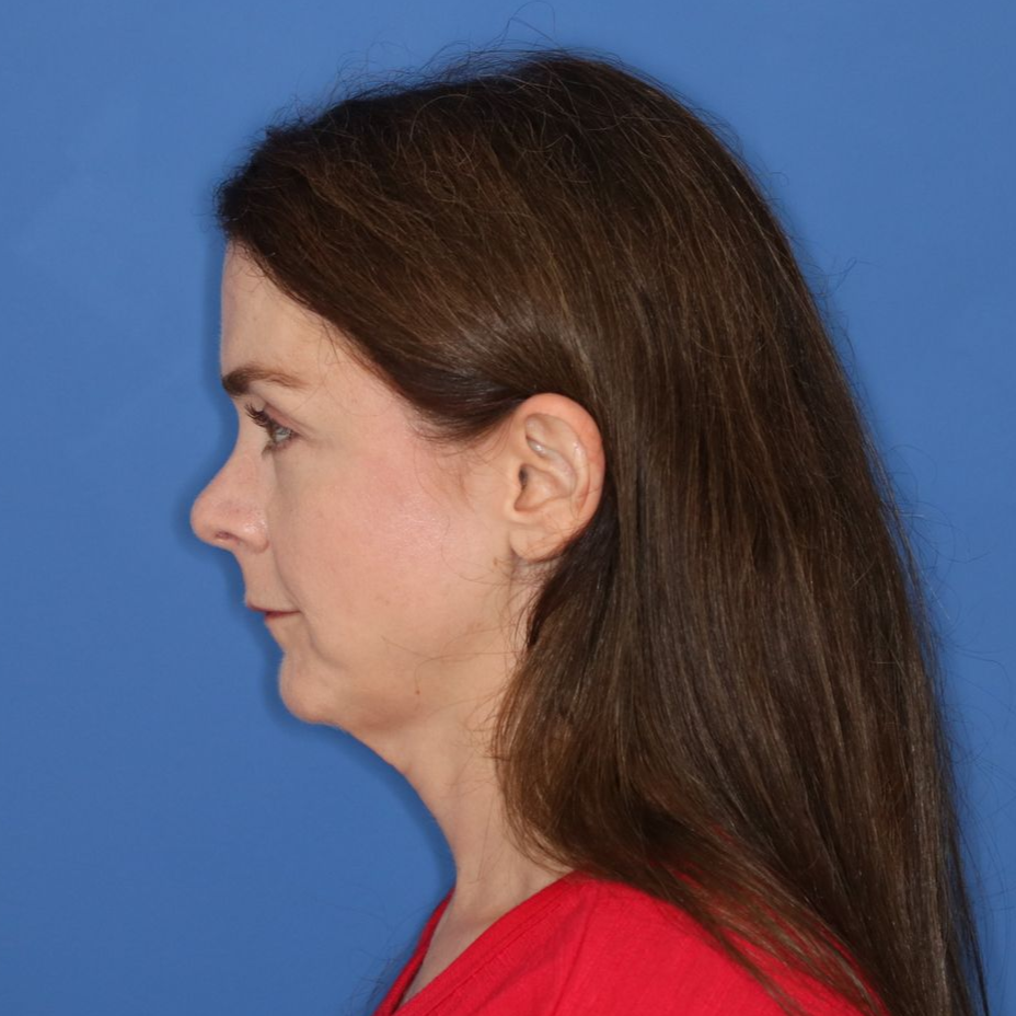 43 year old female before surgery posing for a photo