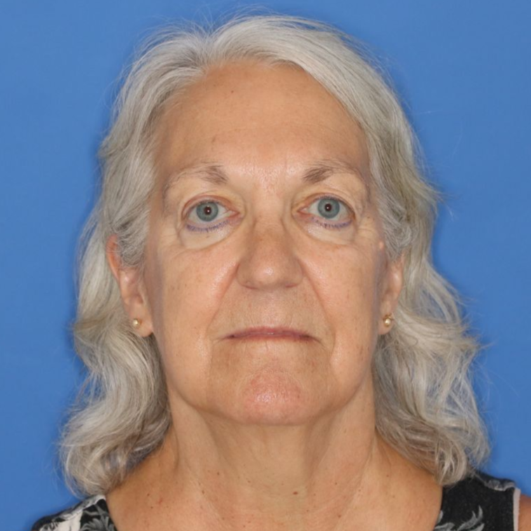 Before photos of a 67 year old female who underwent bilateral upper blepharoplasty under local anesthesia in office.