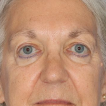 Before photos of a 67 year old female who underwent bilateral upper blepharoplasty under local anesthesia in office. 