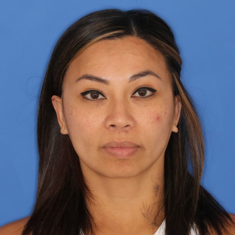 Close up image of a woman's face before lip lift surgery at Carson Williams MD Facial Plastic Surgery office in Leawood KS