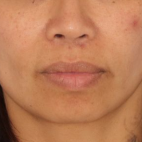 Close up of a woman's lips before receiving a lip lift surgery