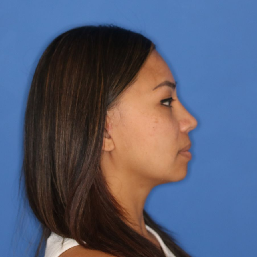 Close up of a woman's side profile before receiving a rhinoplasty surgery