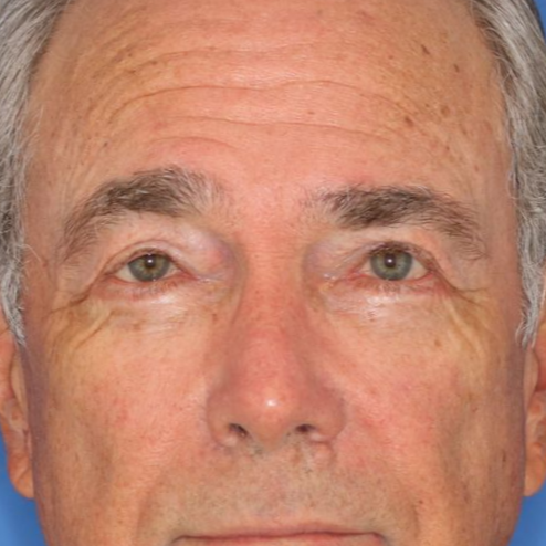 A 72 year old male posing for after photos of a bilateral upper blepharoplasty under local anesthesia in office.