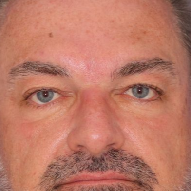 51 year old male posing for a before photo who underwent bilateral upper blepharoplasty.