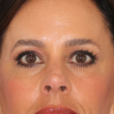 51 year old female before undergoing deep plane face and neck lift, endoscopic brow lift and lower blepharoplasty