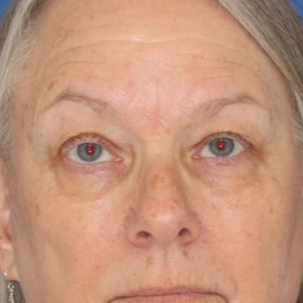 A woman in patterned shirt posing for a before photo of a blepharoplasty.