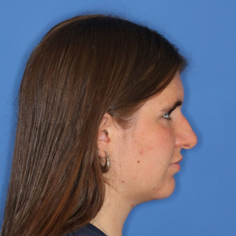 Side profile of a woman before receiving a rhinoplasty