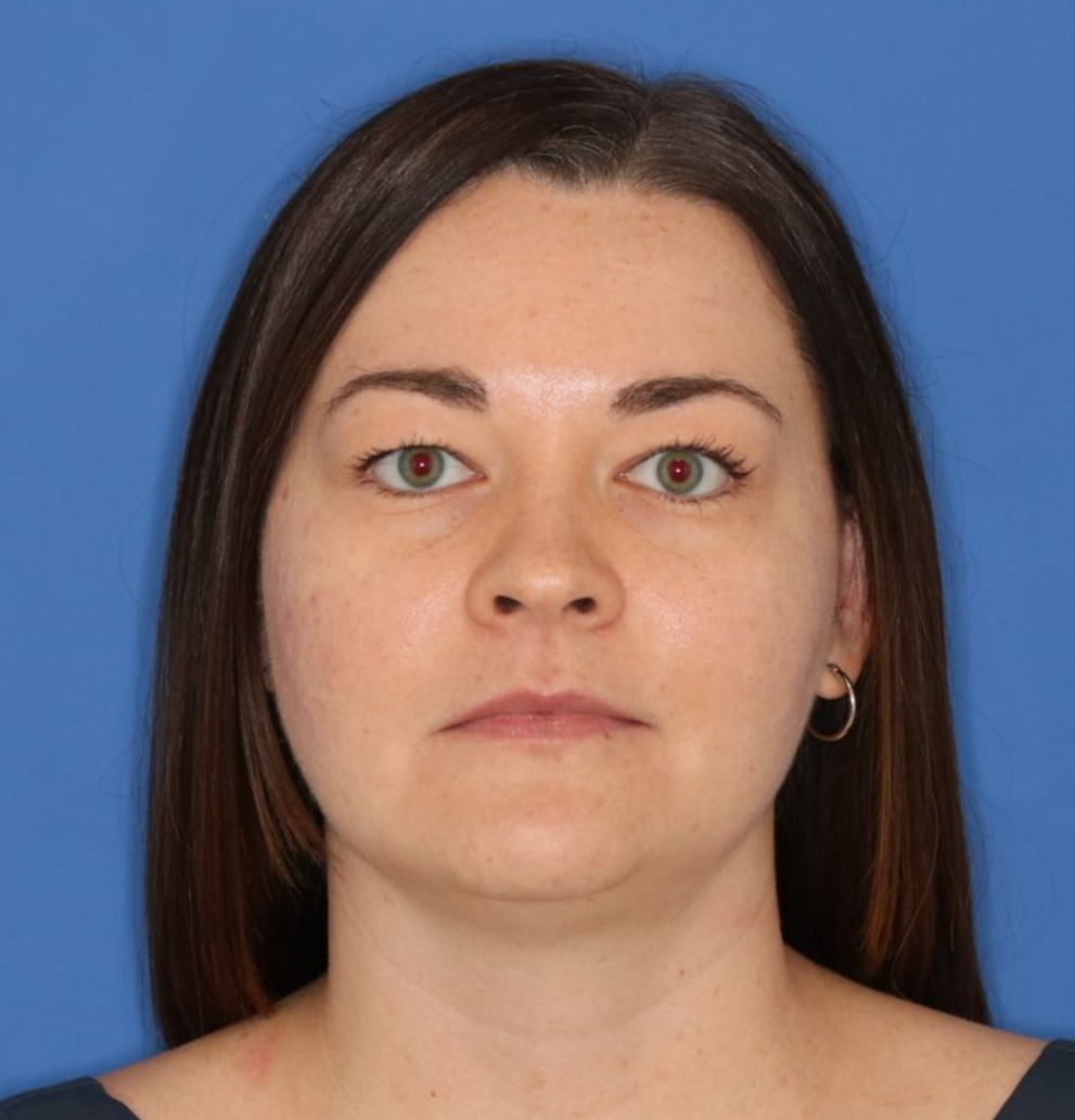 A 35 year old woman before undergoing a blepharoplasty surgery