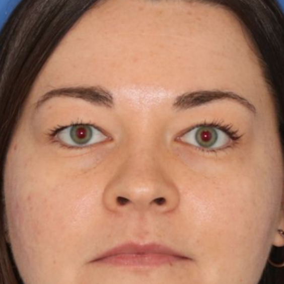 A 35 year old woman before undergoing a blepharoplasty surgery