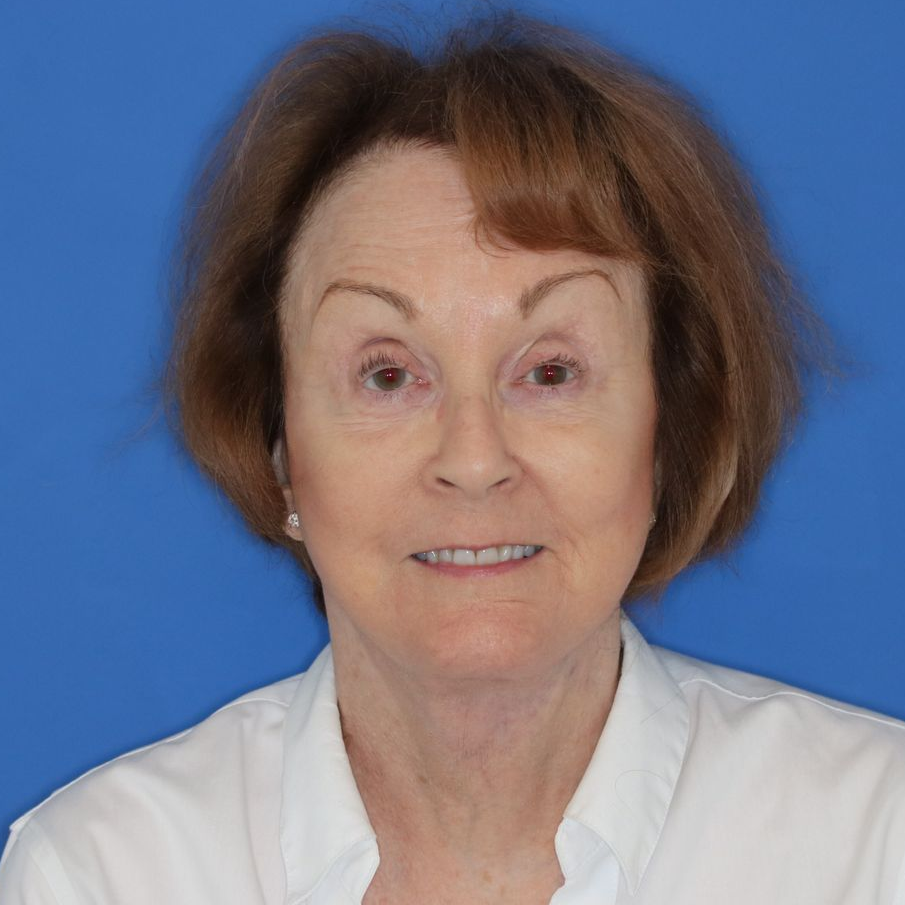76 year old female underwent deep plane face and neck lift posing for after photos