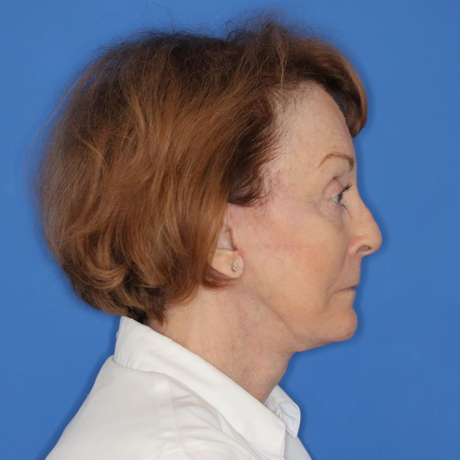 76 year old female underwent deep plane face and neck lift facing to the right for an after photo