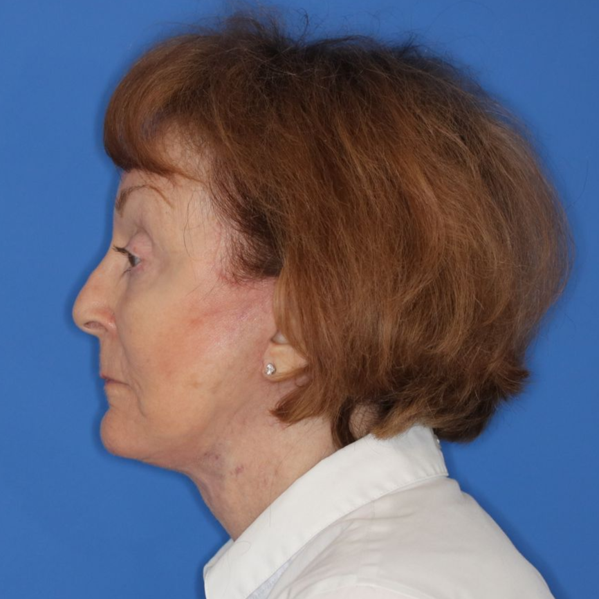 76 year old female facing to the left in front of a blue background posing for after photos