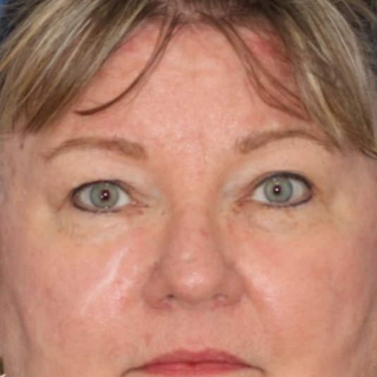 Before photos of a 67 year old female who underwent bilateral upper blepharoplasty.