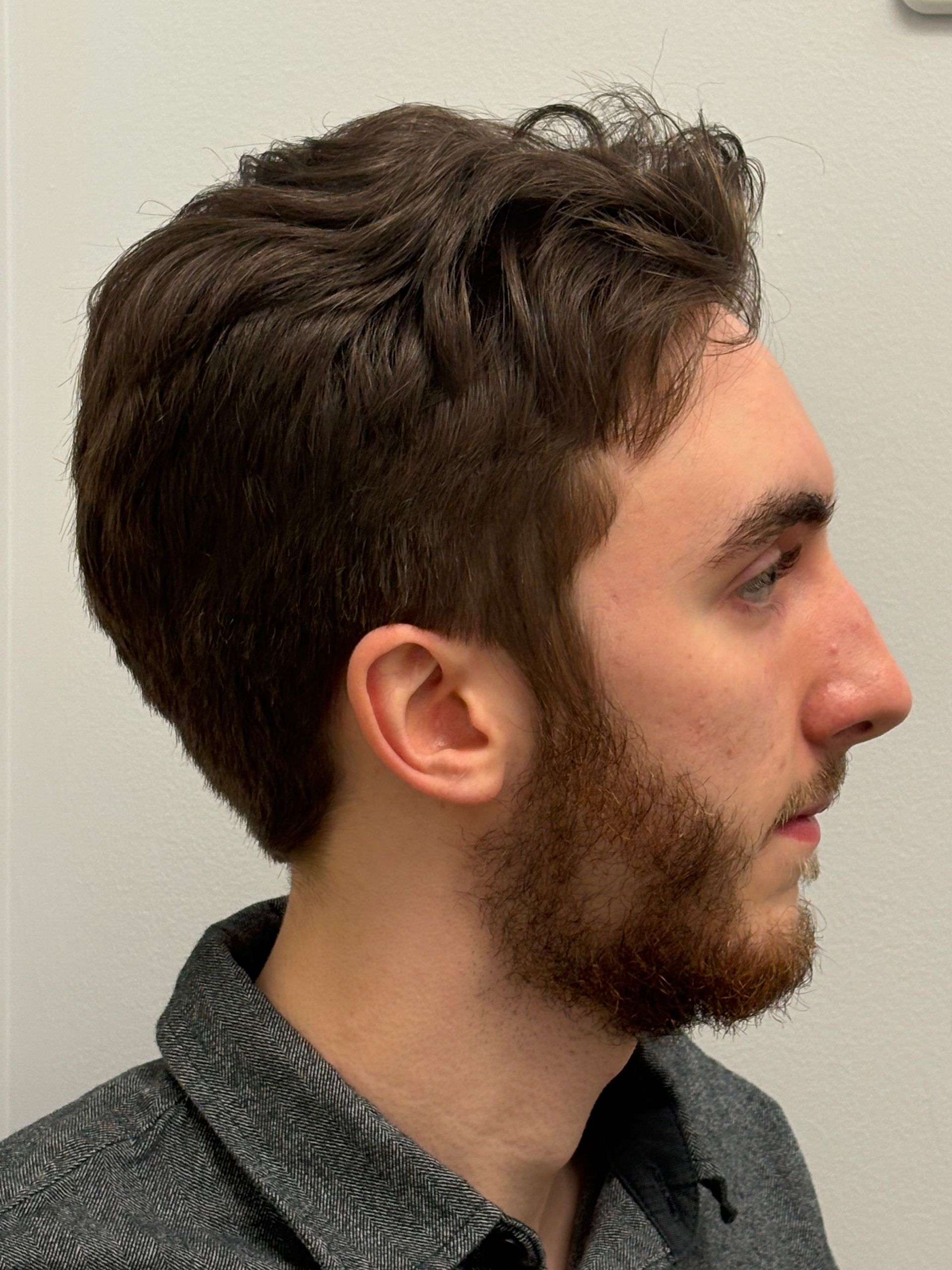 Side profile of a man's face before undergoing a rhinoplasty