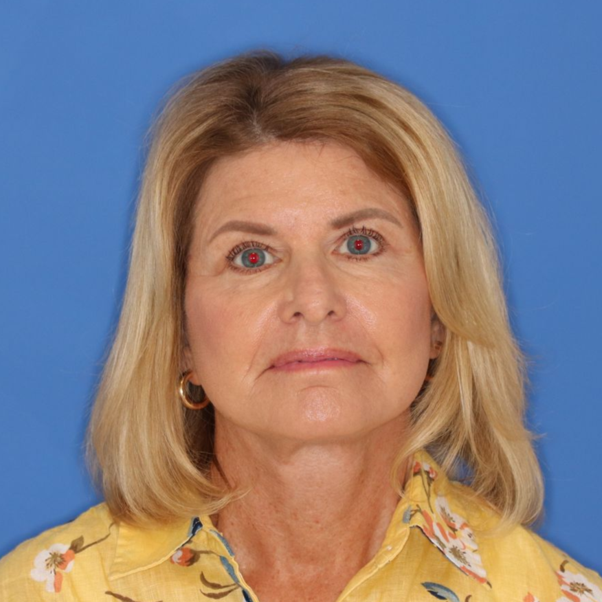 71 year old female underwent deep plane face and neck lift with bilateral upper blepharoplasty posing on a blue background