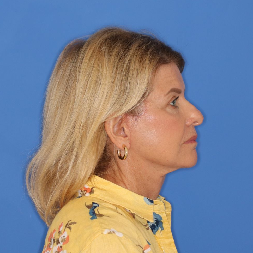 71 year old female underwent deep plane face and neck lift with bilateral upper blepharoplasty posing on a blue background