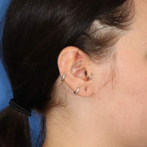 A before picture of a man who underwent Earlobe Repair at Carson Williams MD Facial Plastic Surgery office in Leawood KS