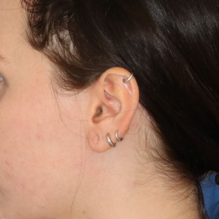 A before picture of a man who underwent Earlobe Repair at Carson Williams MD Facial Plastic Surgery office in Leawood KS