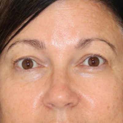 A 51 year old female before photo, who underwent bilateral upper blepharoplasty under local anesthesia in office.