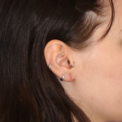 An after  picture of a man who underwent Earlobe Repair at Carson Williams MD Facial Plastic Surgery office in Leawood KS