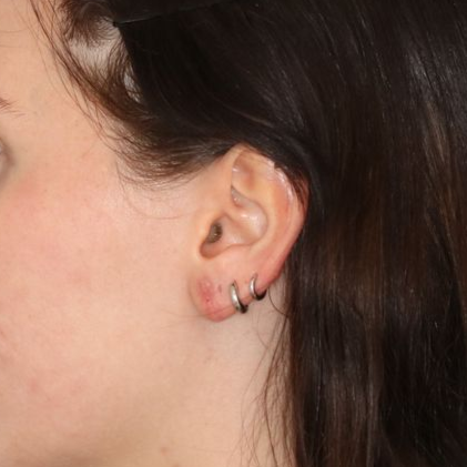 An after  picture of a man who underwent Earlobe Repair at Carson Williams MD Facial Plastic Surgery office in Leawood KS
