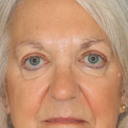 After photos of a 67 year old female who underwent bilateral upper blepharoplasty under local anesthesia in office.